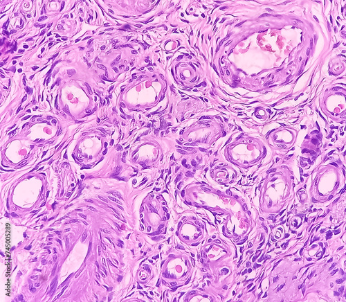 Photo of benign brenner tumor of ovary, showing tumor sheet on the right side and ovarian stroma on the right side. photo