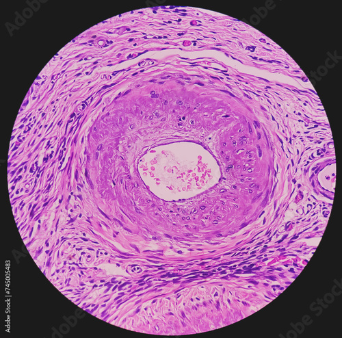 Photo of benign brenner tumor of ovary, showing tumor sheet on the right side and ovarian stroma on the right side. photo