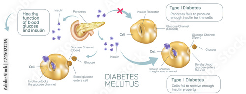 Difference between type one diabetes and type two diabetes. Where body cell do not absorb glucose to balance the insulin level vector illustration. Diabetes mellitus. Diabetes symptoms and prevention. photo