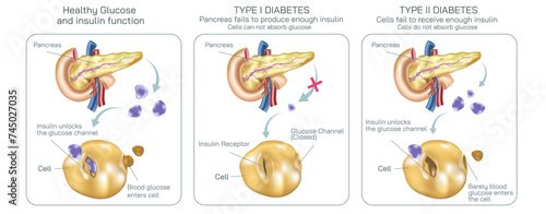 Difference between type one diabetes and type two diabetes. Where body cell do not absorb glucose to balance the insulin level vector illustration. Diabetes mellitus. Diabetes symptoms and prevention. photo