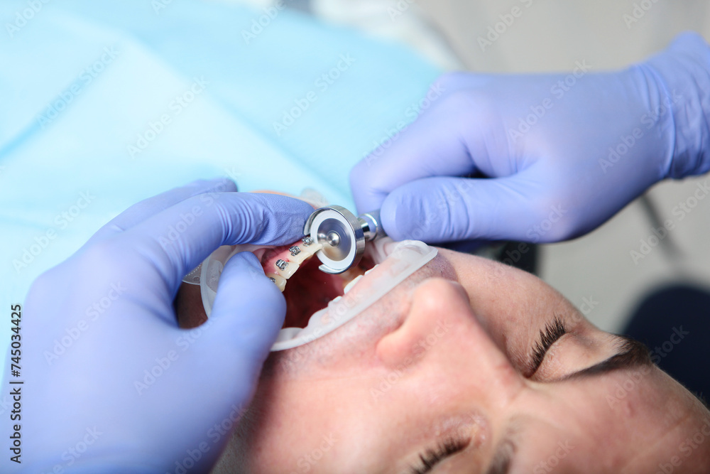 Grinding of tooth enamel. Separation of teeth. Correction of the