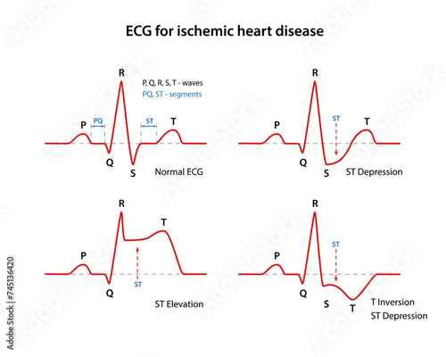 ECG for coronary heart disease. Types of coronary heart disease. Cardiogram of the heart. Vector illustration in flat style
