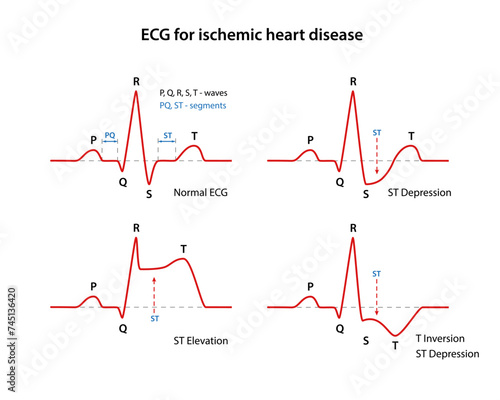 ECG for coronary heart disease. Types of coronary heart disease. Cardiogram of the heart. Vector illustration in flat style
