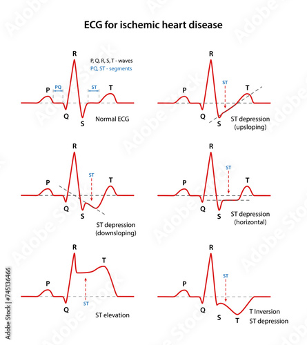 ECG for coronary heart disease. Types of coronary heart disease. Cardiogram of the heart. Vector illustration in flat style