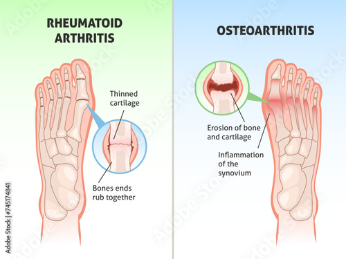 Foot disease poster. Medical orthopedic scheme, foot bones defects, joint with rheumatoid arthritis and osteoarthritis diagnosis, educational scheme, medic poster, tidy vector concept