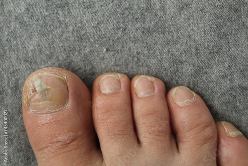 Fotografie Damaged toenail plate close-up. Nail and skin diseases fungus