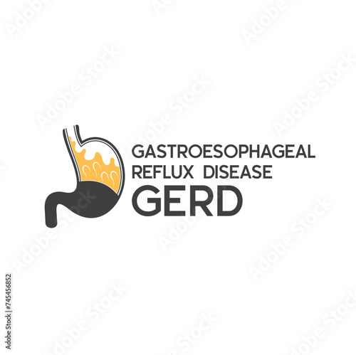 illustration of Gastroesophageal reflux disease or GERD.