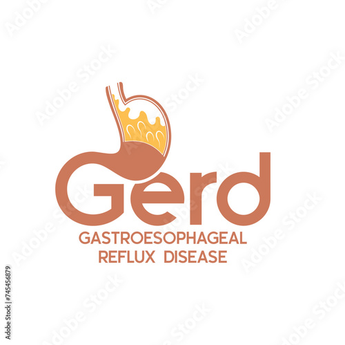 illustration of Gastroesophageal reflux disease or GERD.