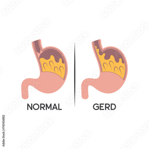 illustration of Gastroesophageal reflux disease or GERD.