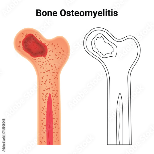 Bone Osteomyelitis Science Design Vector Illustration Diagram