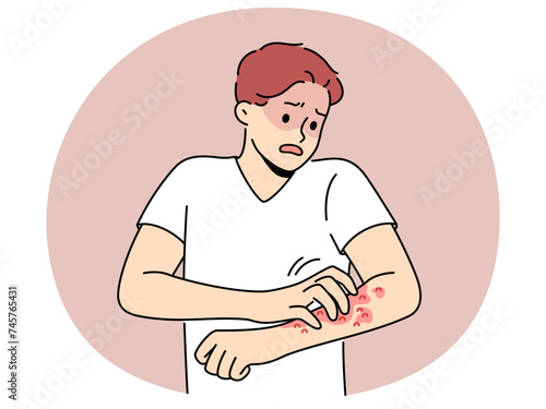 Unhealthy man scratch red pimples on arm suffer from allergy or dermatitis. Stressed unwell guy suffer from itchiness and redness. Healthcare. Vector illustration.