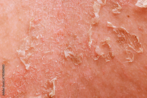 Psoriatic eczema is complex skin disease that demands multidisciplinary approach in dermatology.