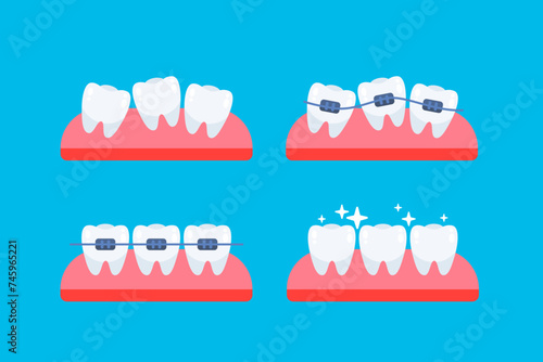 Teeth, orthodontic treatment. Braces on the teeth. Dental care health. Vector illustration