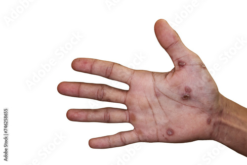 Close up of Secondary stage syphilis sores (lesions) on the palms of the hand. Referred to as 