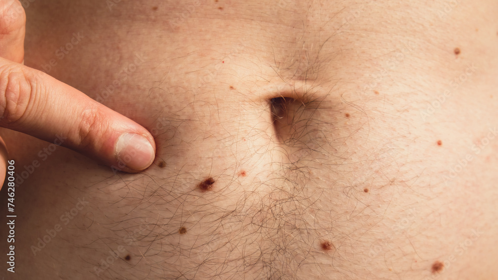Male hand showing birthmarks on skin body stomach part. Close up detail of the bare skin. Health Effects of UV Radiation. Man with birthmarks Pigmentation and lot of birthmarks Male hand showing birthmarks on skin body stomach part. Close up detail of the bare skin. Health Effects of UV Radiation. Man with birthmarks Pigmentation and lot of birthmarks