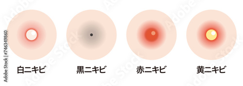 ニキビの種類