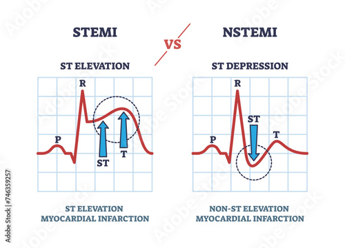 STEMI vs NSTEM heart beat impulse in cardio visualization outline diagram, transparent background. EKG or electrocardiogram with ST elevation and depression comparison illustration.