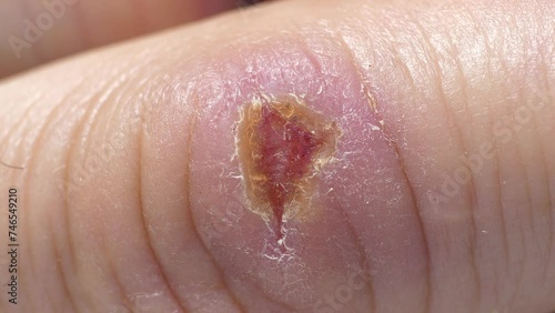 Wound is healing. Self-healing of body. Ten days after injury. There was an injury to middle finger of right hand with bleeding. 4K macro shot video