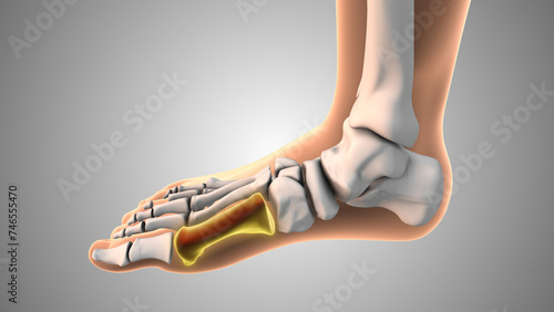 Bilde på lerret Burning and tingling metatarsals red pain