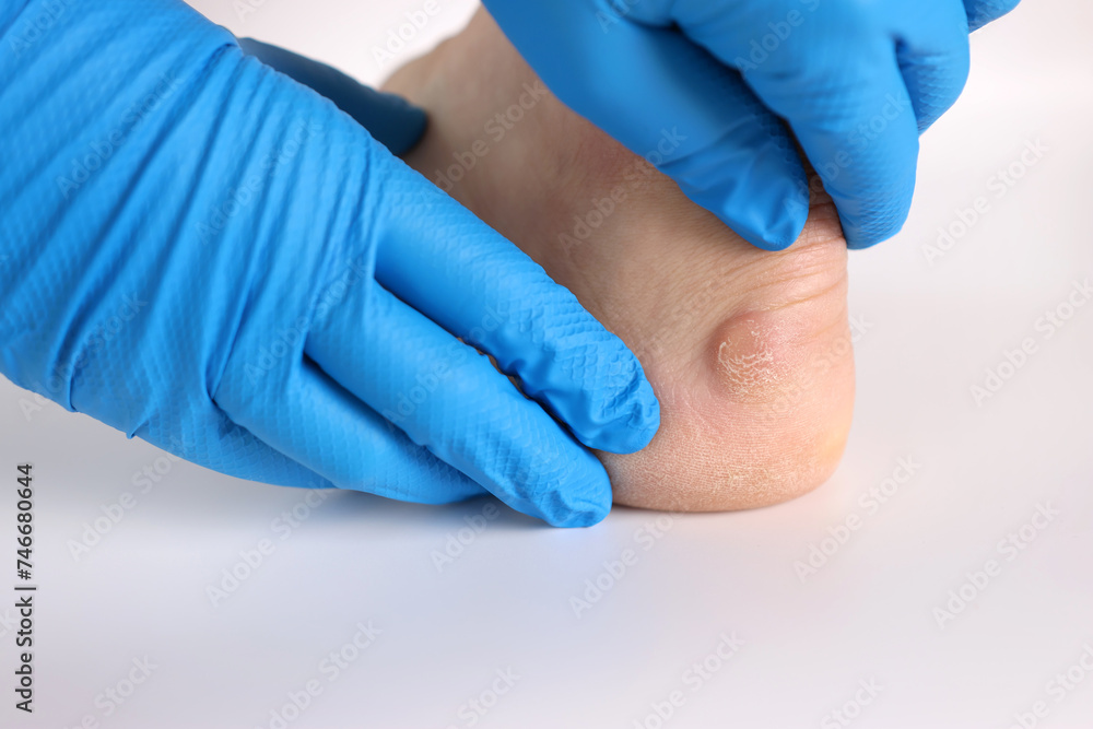 Fototapeta premium A doctor examines calluses on a man's feet. Treatment of corns on the feet.