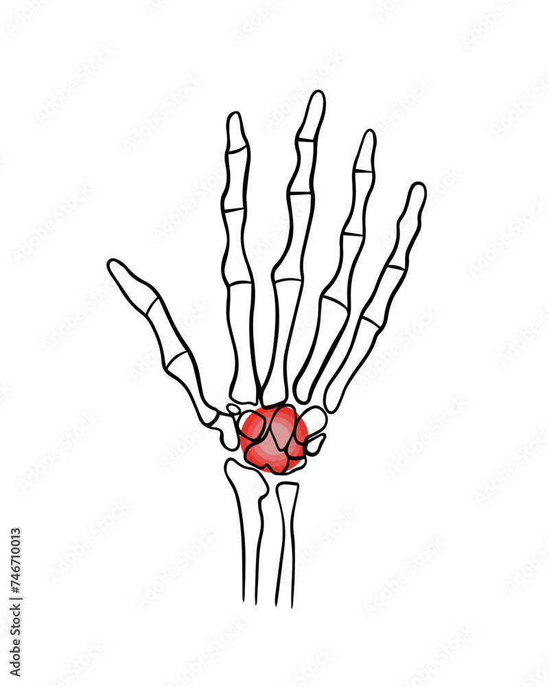 Obraz premium Vector isolated illustration of wrist pain. Hand with localization of pain in the wrist.