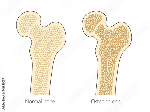 human bone structure with osteoporosis diagram hand drawn schematic vector illustration. Medical science educational illustration