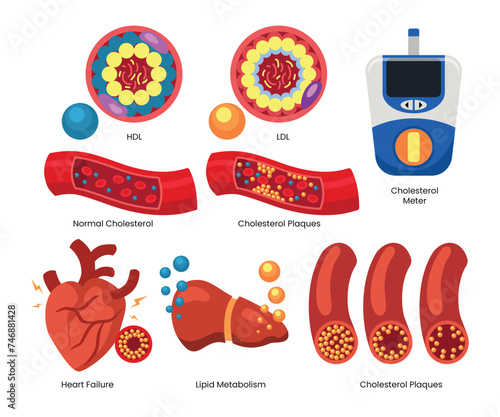 Set of cholesterol elements objects set collection with HDL and LDL lipoprotein, cholesterol meter, heart failure, lipid metabolism, Labeled educational normal and narrowed artery cross section.