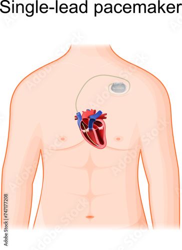 Single lead pacemaker placement. Сross section of heart and artificial cardiac pacemaker.