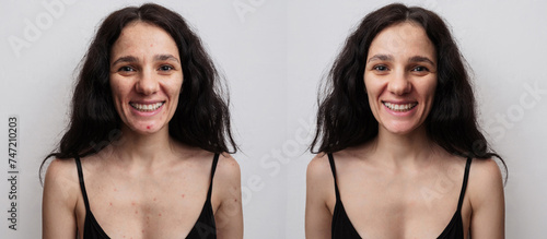 A young woman before and after acne treatment on a beige background photo