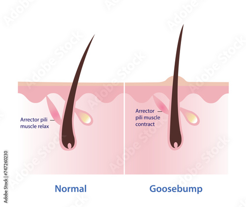Goosebumps on the skin vector illustration isolated on white background. Comparison of normal skin, arrector pili muscle relax and goosebumps, arrector pili muscle contract, pull the hair straight up.