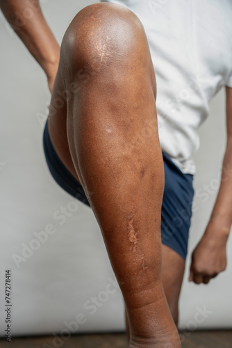 Man showing leg with scars against gray background