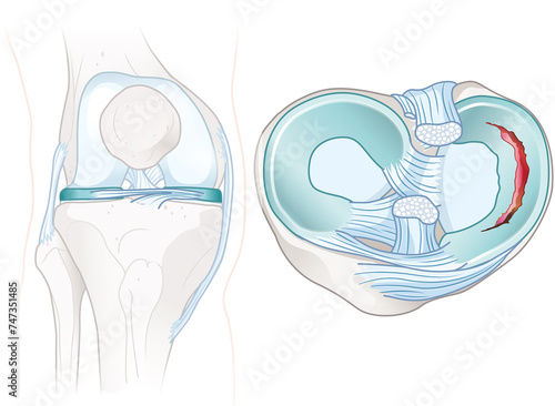Fotografi Meniscus tears anatomy. Medically illustration