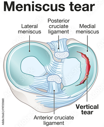 Meniscus tear anatomy. Labeled illustration photo