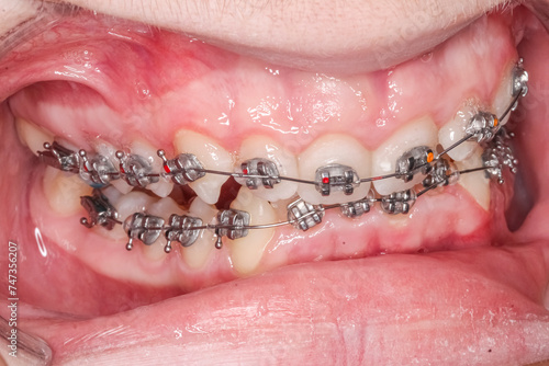 Oblique lateral view of dental arches, misaligned biting teeth with anterior deep bite malocclusion, orthodontic braces, arch wire, crooked teeth, cheeks and lips retracted with cheek retractor.