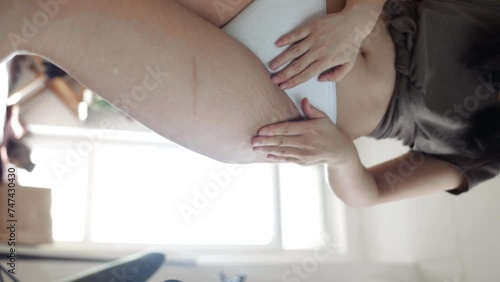 Cream for skin stretching and cellulite. Stretch marks on a woman's legs. Vertical video of woman's hand holds fat cellulite and stretch marks on her leg. photo