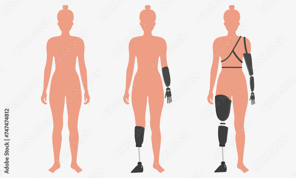 Disabled woman wearing innovative exoskeleton, Artificial limb leg, prosthesis Disabled woman wearing innovative exoskeleton, Artificial limb leg, prosthesis