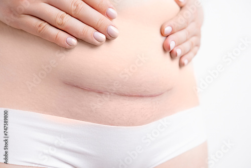 Woman belly with a scar from a cesarean section on the white background.