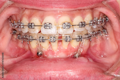 Orthodontics teeth alignment treatment with braces and elastic ligatures, anterior diastema gap between lower central incisors and gingival recession periodontitis. Mini implants in the lower mandible