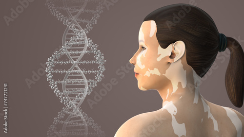 Leukoderma or Vitiligo caused by hormonal imbalance medical animation photo