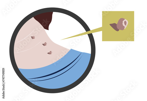 Skin Tags medical condition being highlighted. Editable Clip Art. photo