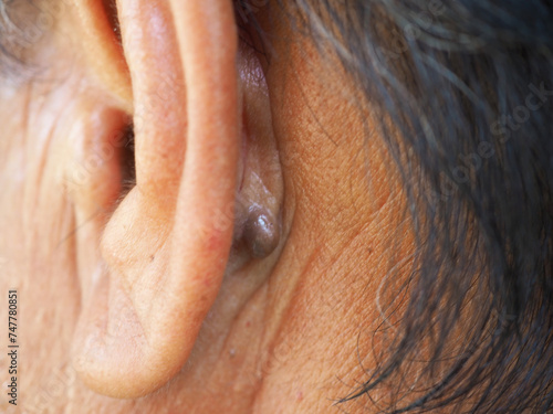 Sebaceous cysts on his neck, formed by sebaceous glands. Oils called sebum and laser skin treatments or flea biopsies health concept. Closeup photo, blurred.