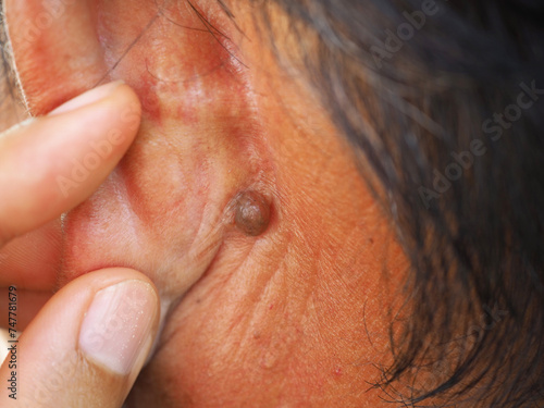 Man pointed to sebaceous cysts on his neck, formed by sebaceous glands. Oils called sebum and laser skin treatments or flea biopsies health concept. closeup photo, blurred. photo