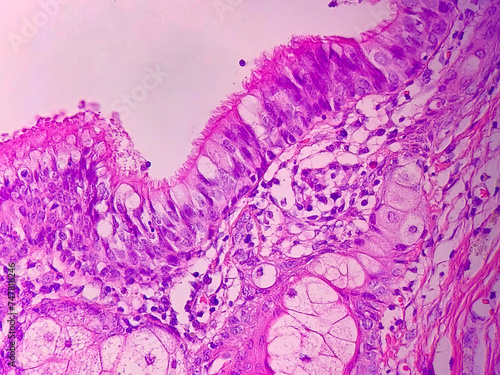 ciliated epithelium in ovarian teratoma 40x photo