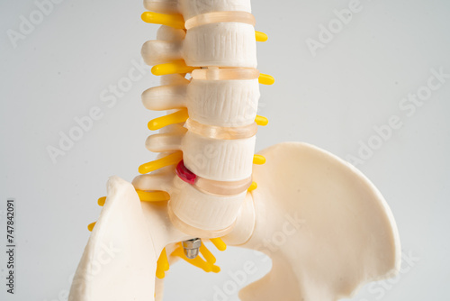 Lumbar spine displaced herniated disc fragment, spinal nerve and bone. Model for treatment medical in the orthopedic department. photo