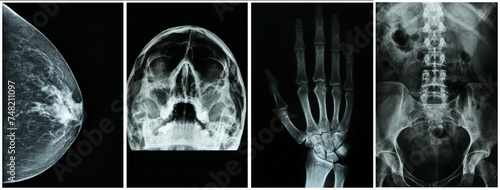 Set of X-Ray of different body parts like breast, head, hand and spine. Medical concept.