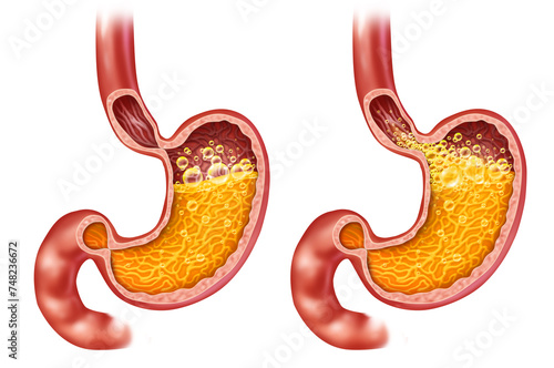 Acid Reflux And Heartburn or Gastroesophageal disease or GERD as an open sphincter with an iflamed esophagus as a medical symbol for regurgitation and a burning sensation in the chest.