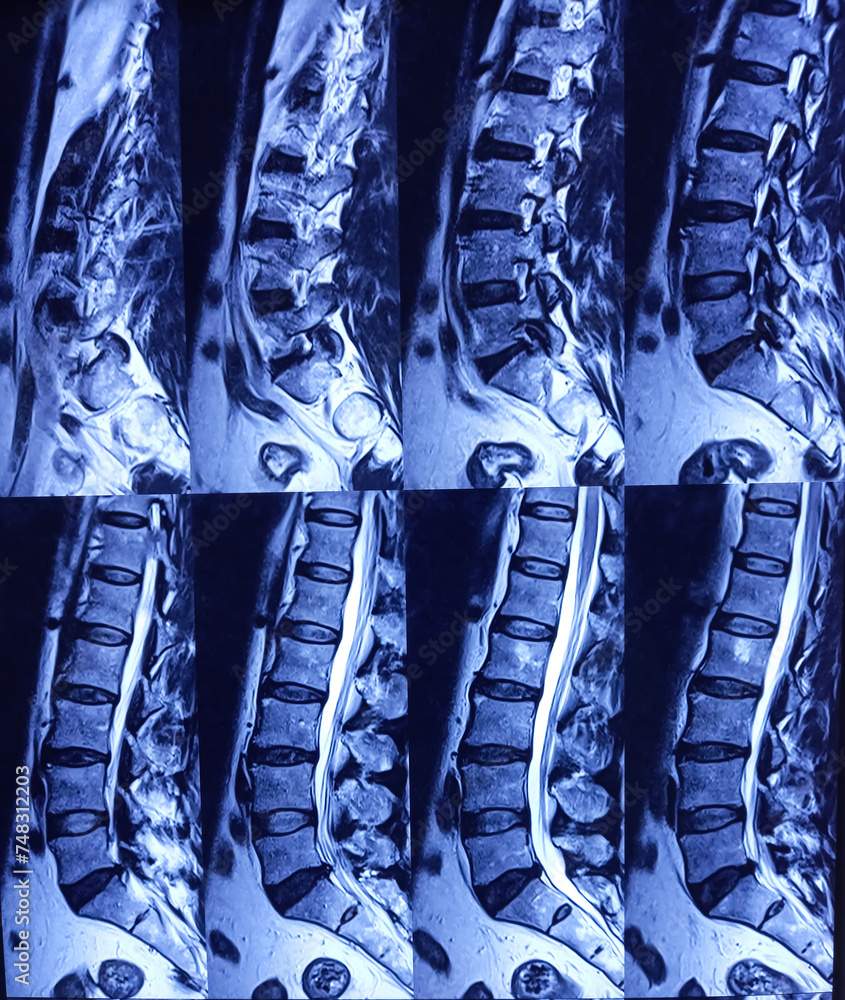 MRI resonance imaging) of Lumbo sacral Spine. L4L5 and L5S1