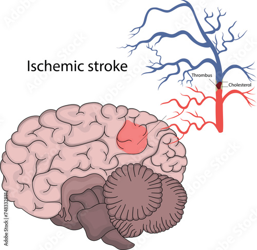 Vector illustration of ischemic stroke. Brain infarction.