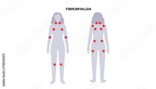 Fibromyalgia medical poster