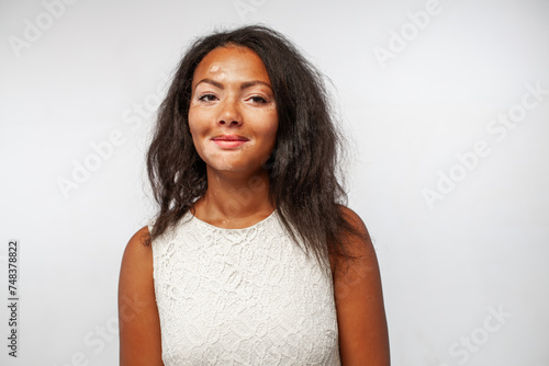 Happy black woman with skin problems Vitiligo disease looking at camera and smiling. Portrait of beautiful Arican lady standing on white background. photo